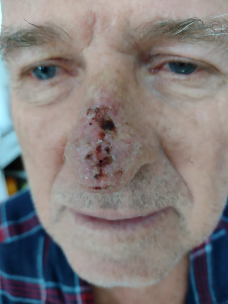 foto do nariz de Antenor todo ferido