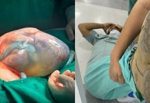 VÍDEO – Gêmeos empelicados: pai desmaia ao ver nascimento de filho em condição rara em Santa Catarina